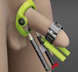 Rehabilitation after an operation to increase the penis