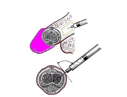 Pumping petroleum jelly into the penis to increase