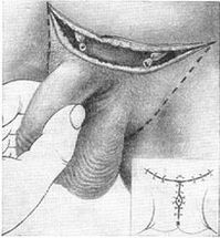 Surgical lengthening of the penis by pulling out the hidden part