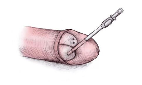 The head of the penis can be enlarged by injecting hyaluron gel